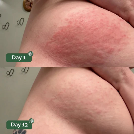 undercareskin