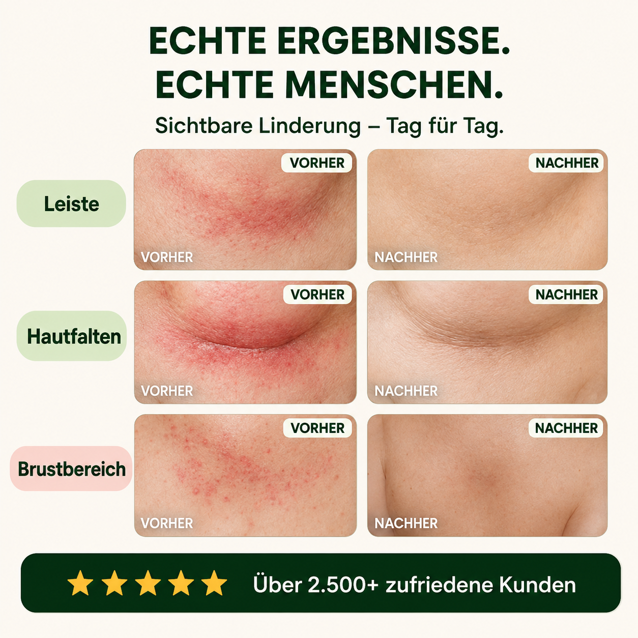 3× HEALORA™ Intertrigo-Linderungscreme – exklusives Zusatzangebot mit zusätzlichen 50 % Rabatt